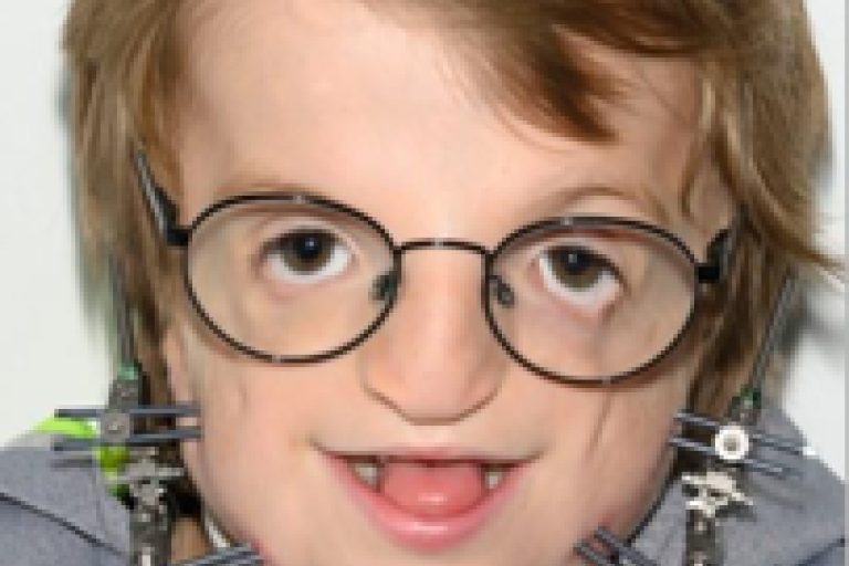 portrait photo of 7-year-old William, born with Treacher Collins syndrome